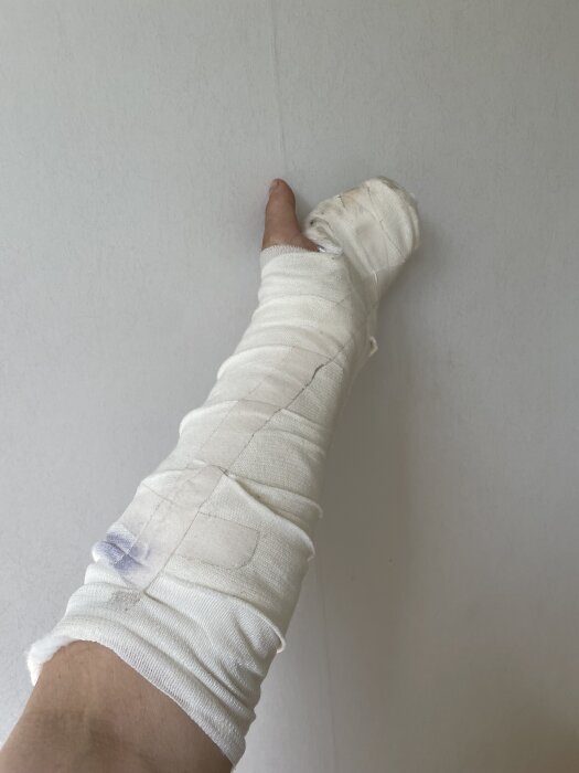 En arm inlindad i bandage efter en skada, troligen orsakad av en sågolycka vid användning av vinkelkap med sågklinga för trä.