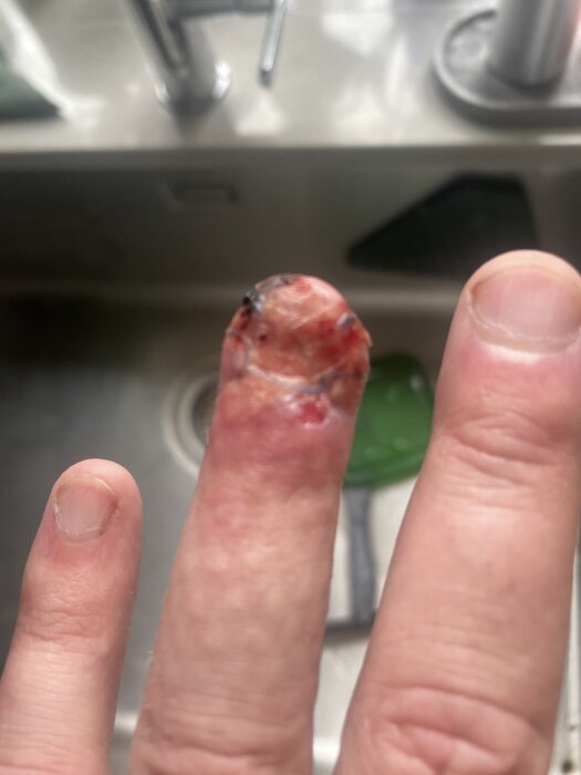 Skadat finger med sår och blåmärken efter en olycka. Bilden är tagen i ett kök med diskbänk i bakgrunden.