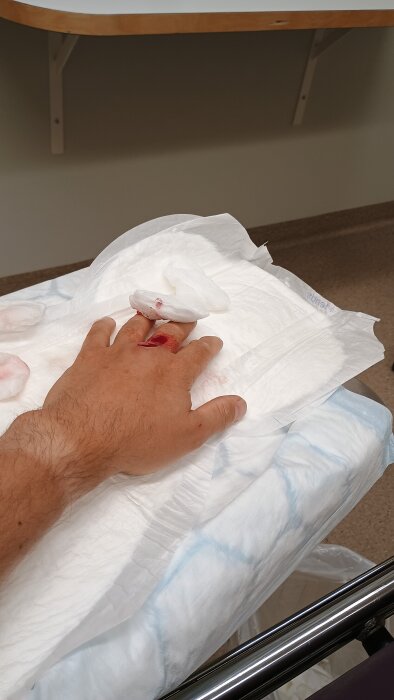 Hand med sår på fingret ligger på sjukhusbädd med vita gasbindor efter en olycka under träbearbetning.