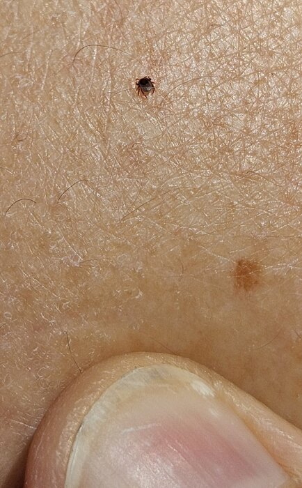 Fästingnymf som sitter fast på huden nära en nagel.