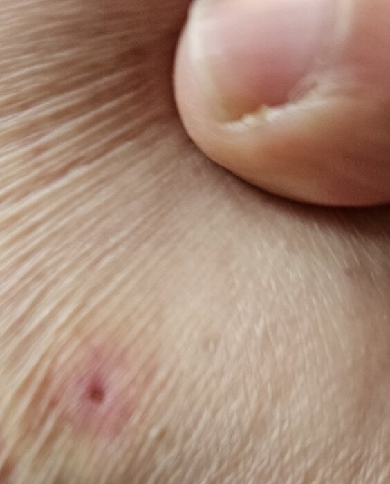 Röd prick på huden där en fästing tidigare suttit fast, bilden visar läkningsprocessen två veckor efter borttagning.