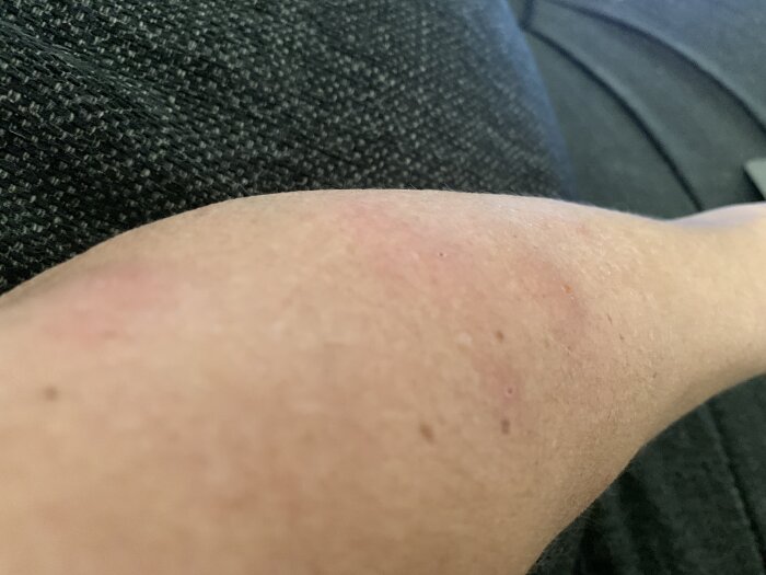 Rödflammiga bett på en arm mot mörk bakgrund.