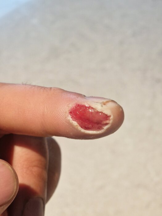 Skadat finger med djupt sår och avskrapad hud, antagligen orsakad av en olycka under byggarbete.