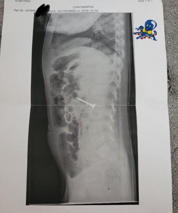 Röntgenbild av en kropp med en skruv synlig i magområdet.