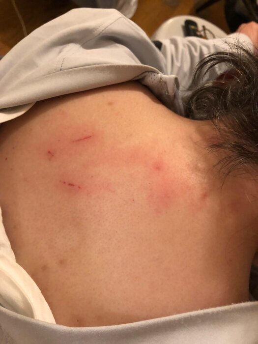 Rödaktiga utslag och rivmärken på en persons rygg, potentiellt från insektsbett.