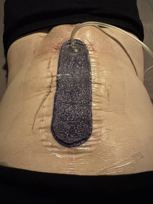 Kropp med sugförband över sår täckt av plast, för att minska svullnad och infektion. Slang ansluten till förbandet för dränering.