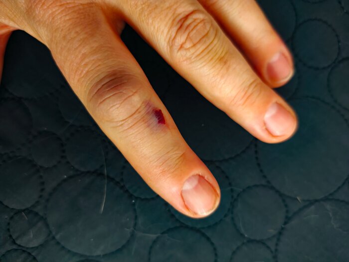 Skadad finger med ett blåmärke på ovansidan, placerat mot ett mörkt underlag.