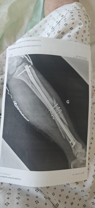 Röntgenbild av ett ben med metallstift och plåt, personen bär sjukhuskläder i bakgrunden.